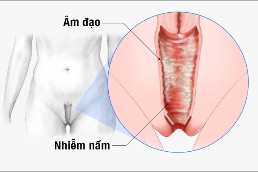 nguyen-nhan-ngua-am-dao-2
