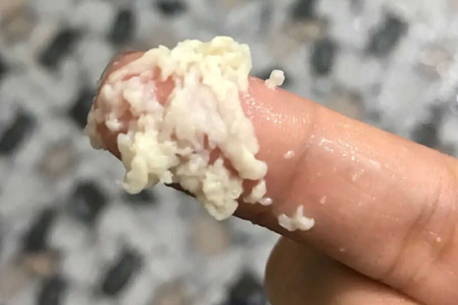 nhiem-nam-candida-vung-kin-2