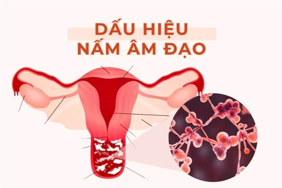 nhiem-nam-candida-vung-kin-3